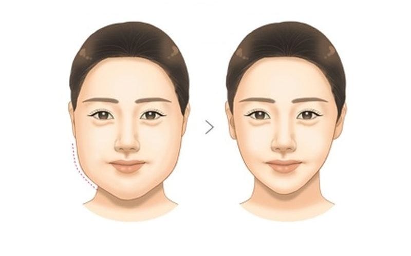 Tiêm tan mỡ hay hút mỡ / công nghệ lạnh / HIFU — nên chọn phương pháp nào cho trường hợp của tôi?