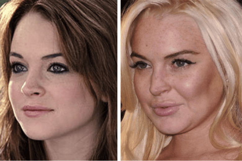 Biến chứng botox do lạm dụng: hậu quả với khuôn mặt và sức khỏe