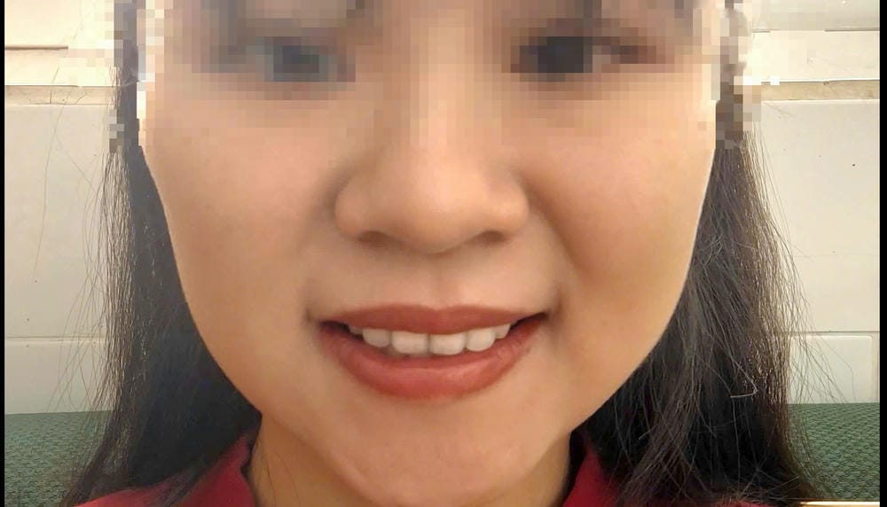 Phân biệt biến chứng do lạm dụng và do botox giả
