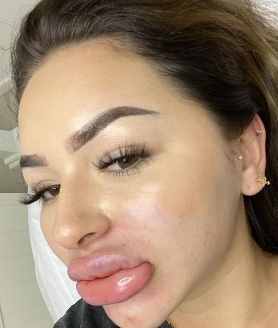Lạm dụng tiêm filler là gì — tại sao chỉ vài mũi cũng có thể trở thành vấn đề?
