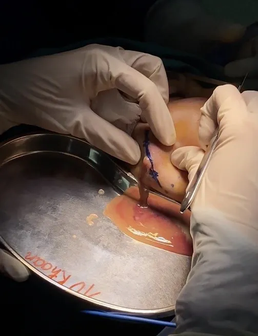 Phản ứng viêm, granuloma và nhiễm trùng