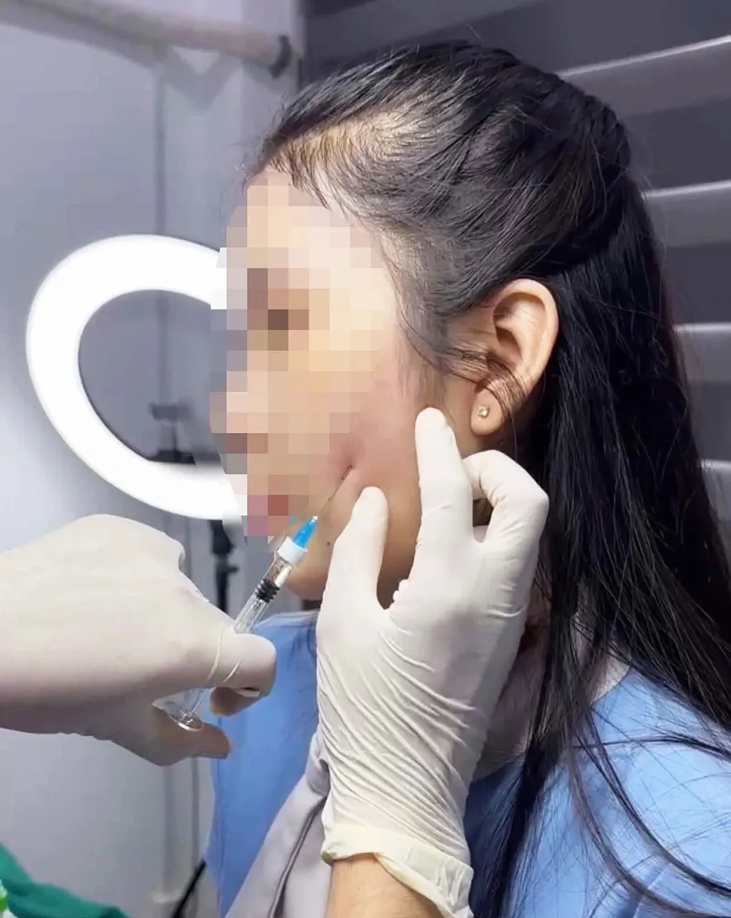 Điều gì nếu đã lạm dụng filler nhiều năm — còn hy vọng phục hồi không?