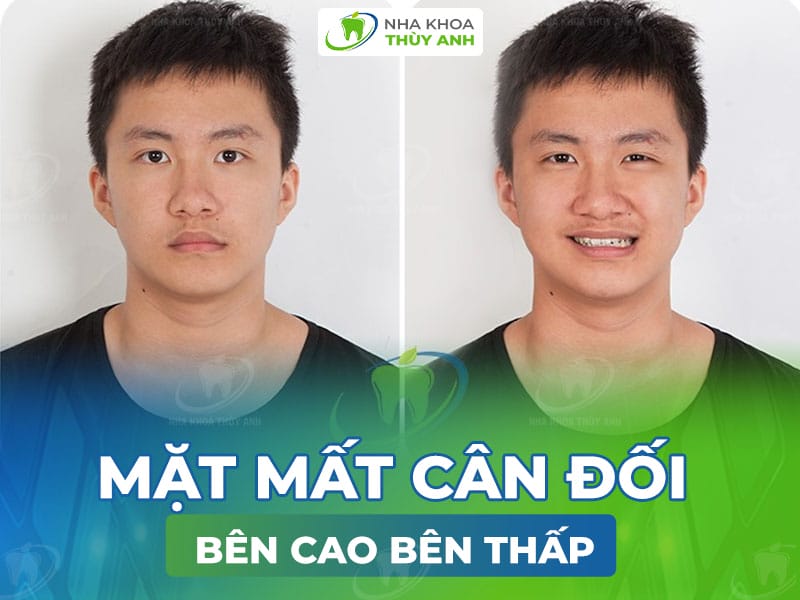 Những điểm an toàn bắt buộc khi tiêm filler cằm