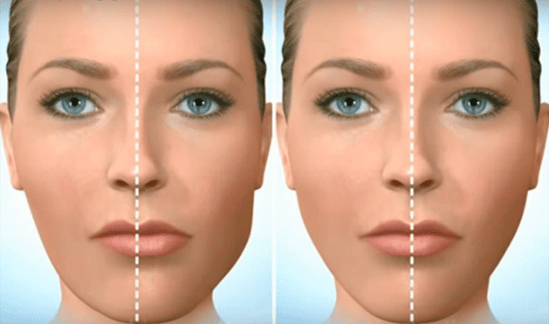 Phẫu thuật chỉnh cằm (genioplasty) thực hiện thế nào và khi nào cần nghĩ tới phẫu thuật?
