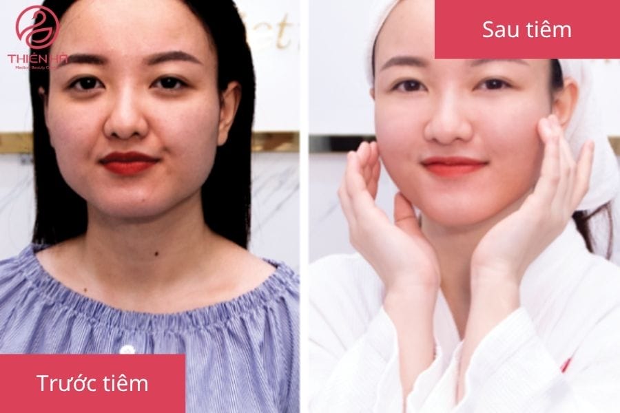 Cơ chế tác động của tiêm filler HA: filler hoạt động như thế nào?