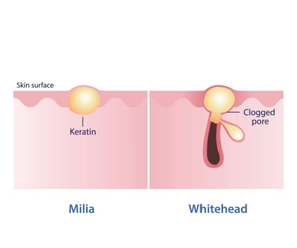 Milia có tự hết không — khi nào cần can thiệp tại clinic?