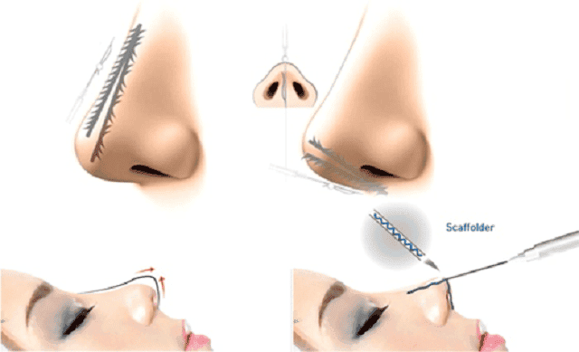 Về cơ chế: chỉ nâng mũi và filler hoạt động khác nhau như thế nào?