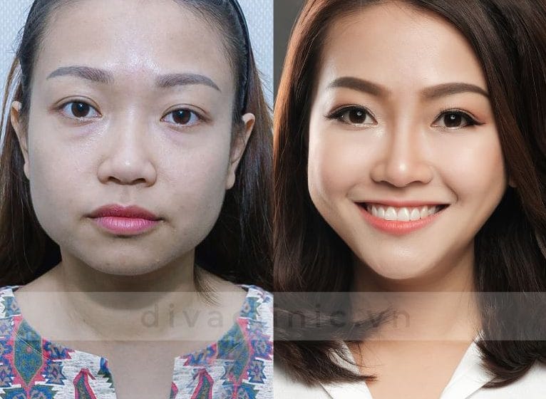 Tiêu chí chọn nơi tiêm an toàn cho mũi đã phẫu thuật