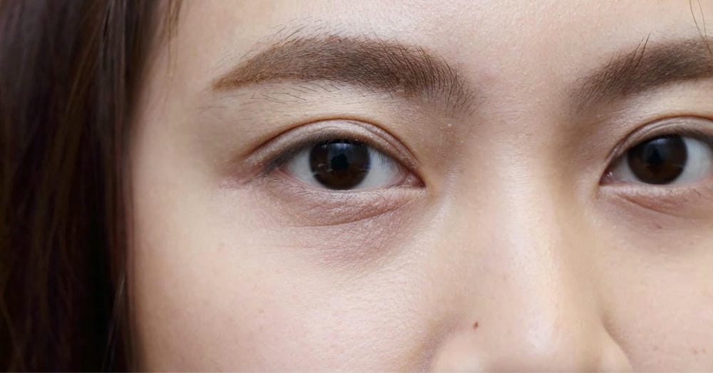 Nếu quyết định tiêm filler dưới mắt — quy trình an toàn chuẩn tại clinic là gì?