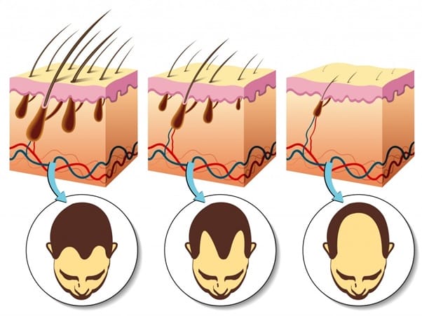 Finasteride (uống — chỉ theo chỉ định bác sĩ)