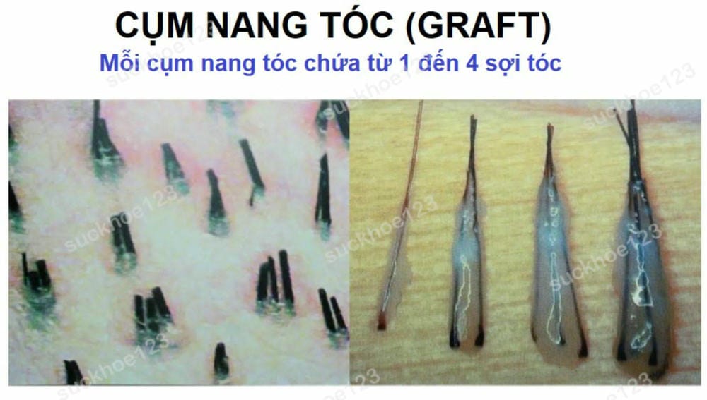 Nang tóc khi nhổ ra thường có những màu nào — và mỗi màu nói lên điều gì?