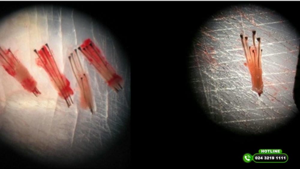 Bằng chứng lâm sàng và trichoscopy: đâu là nguồn tin đáng tin cậy?