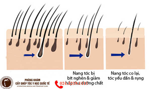 Thuốc tại chỗ và đường uống — minoxidil, finasteride, dutasteride và lựa chọn an toàn