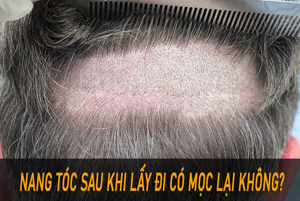 Quy trình cấy tóc thường gồm những bước nào?