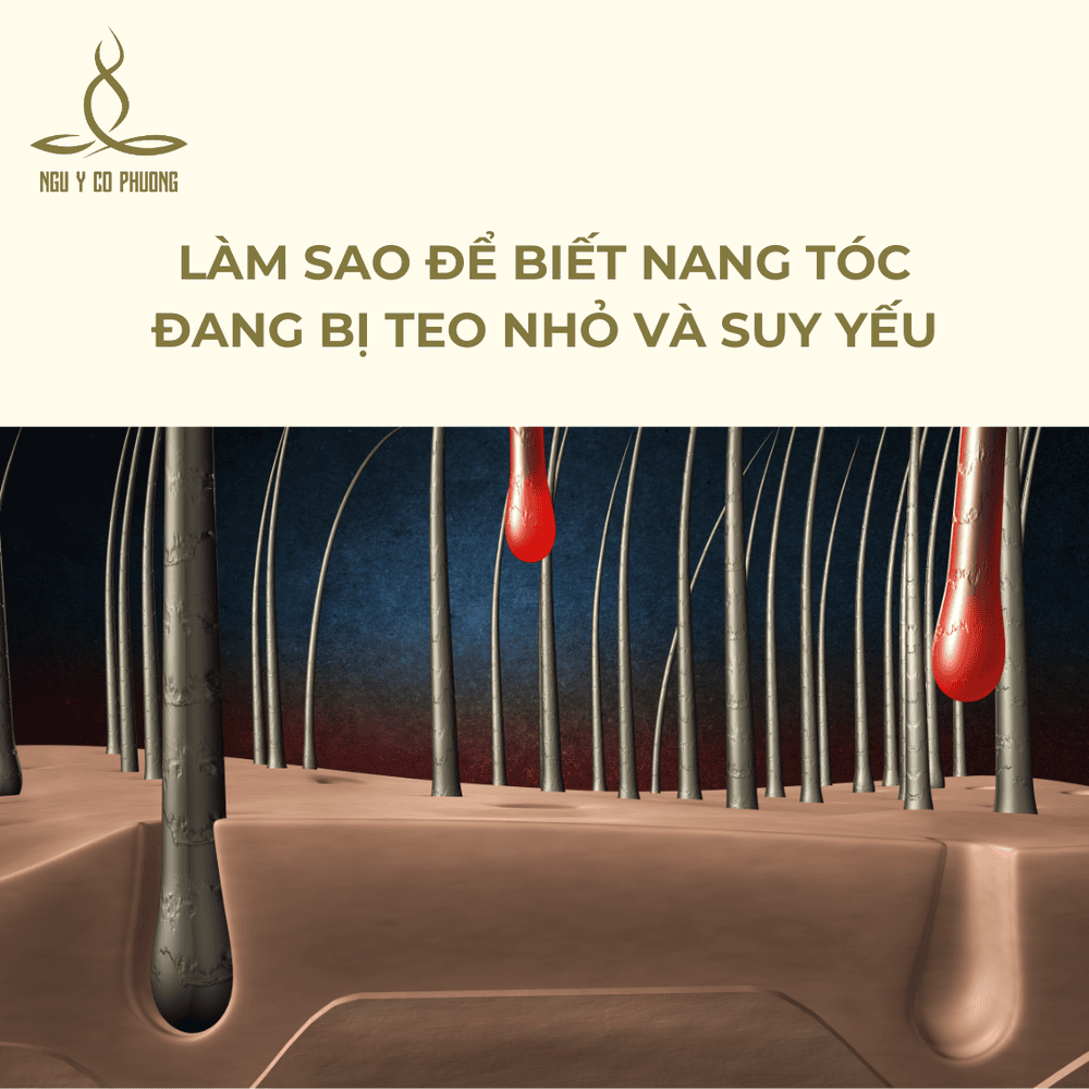 PRP tóc (huyết tương giàu tiểu cầu): hi vọng và giới hạn