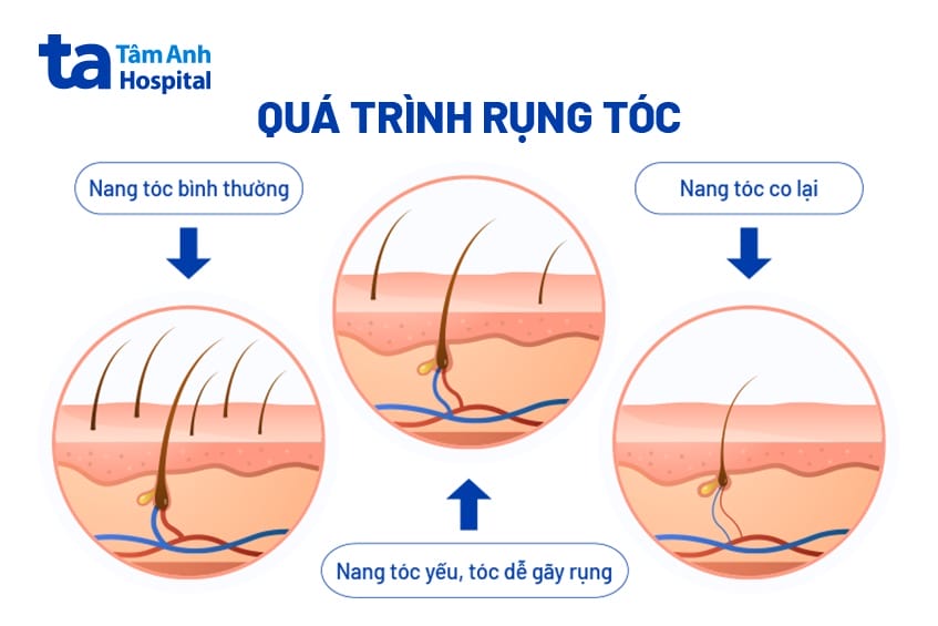 Khi nào cần nghĩ tới cấy tóc — và cấy tóc có chữa được nang tóc yếu không?