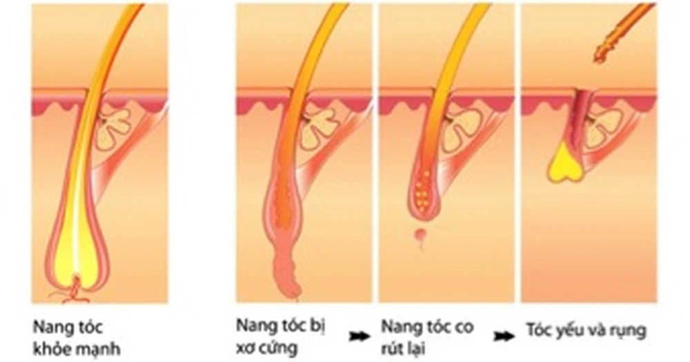 Thuốc uống ức chế 5α-reductase (finasteride, dutasteride)