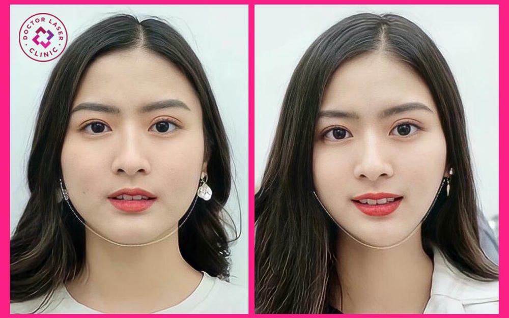Tuổi tác và lão hoá ảnh hưởng tới nọng cằm thế nào?