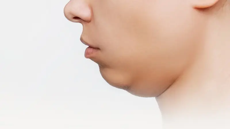 2) Tiêm axit deoxycholic (tan mỡ cằm)