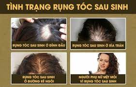 Tại sao tóc rụng nhiều sau sinh — có phải chỉ do hormone không?