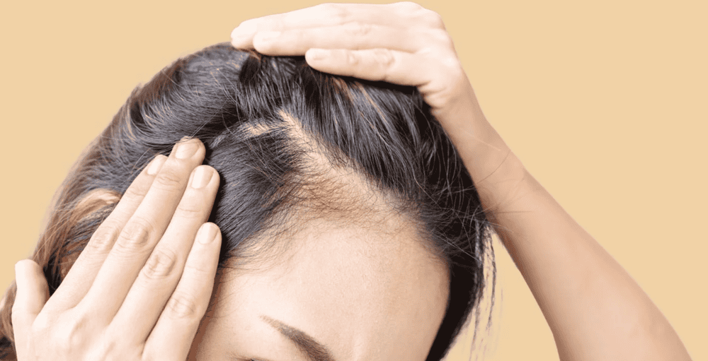 PRP, cấy tóc, laser, microneedling — những liệu pháp thẩm mỹ có thật sự giúp ngăn rụng tóc?
