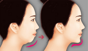 Quy trình tổng quát của một ca phẫu thuật chỉnh cằm