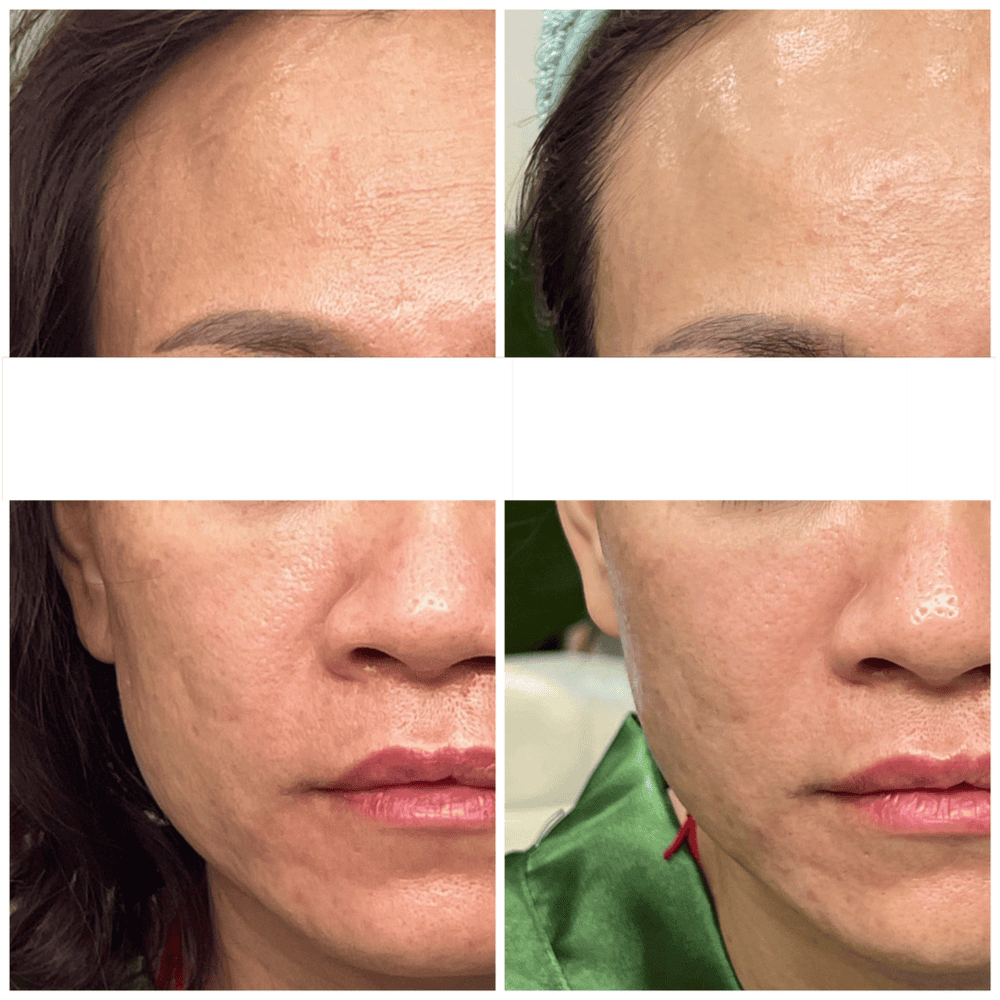 Chuẩn bị trước và chăm sóc sau để tiêm botox an toàn