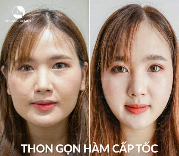 Tiêm lần đầu có nên bắt đầu liều thấp không?
