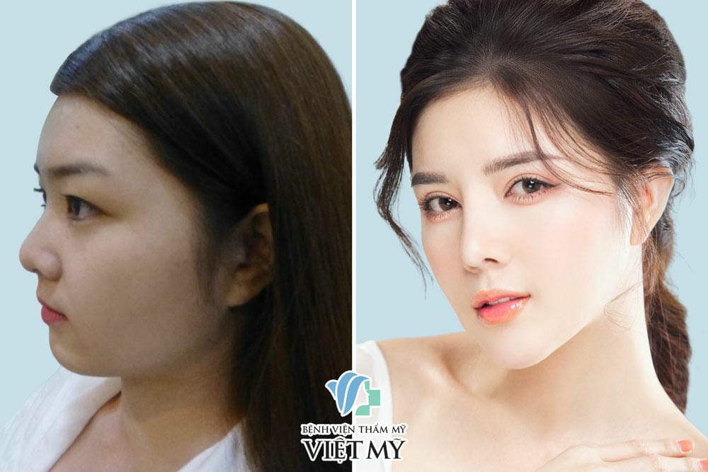 Nâng cằm bằng filler cằm hay phẫu thuật: phương pháp nào phù hợp?