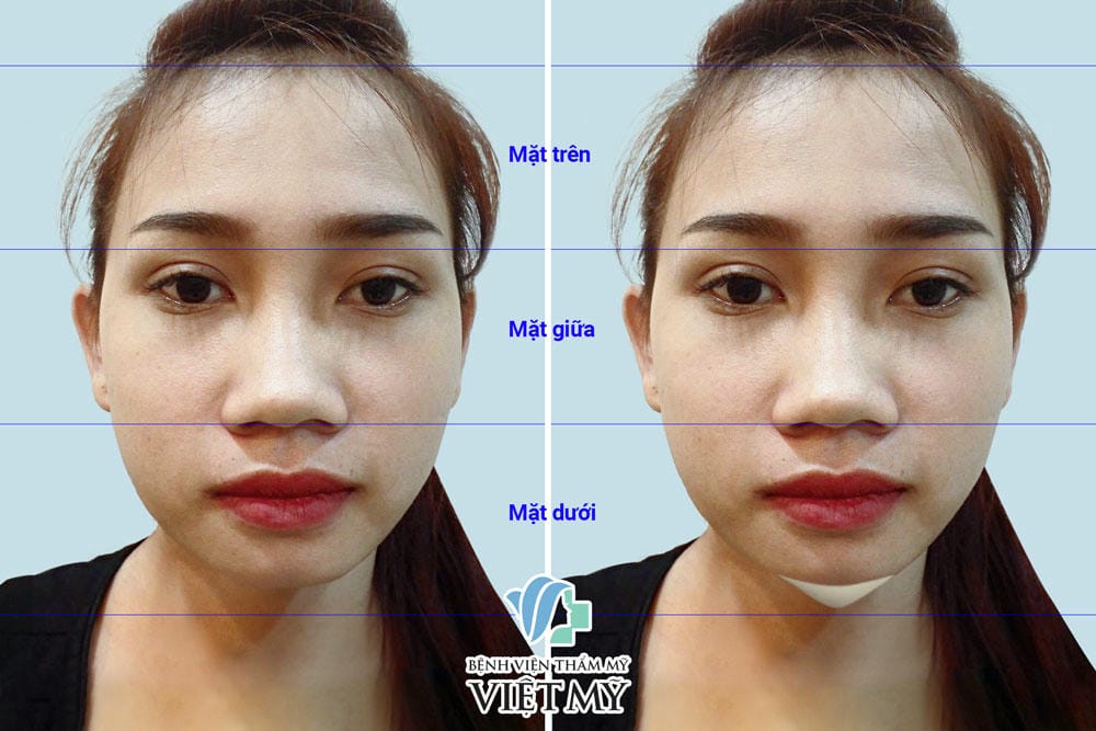 Quy trình nâng cằm an toàn gồm những bước cụ thể nào?