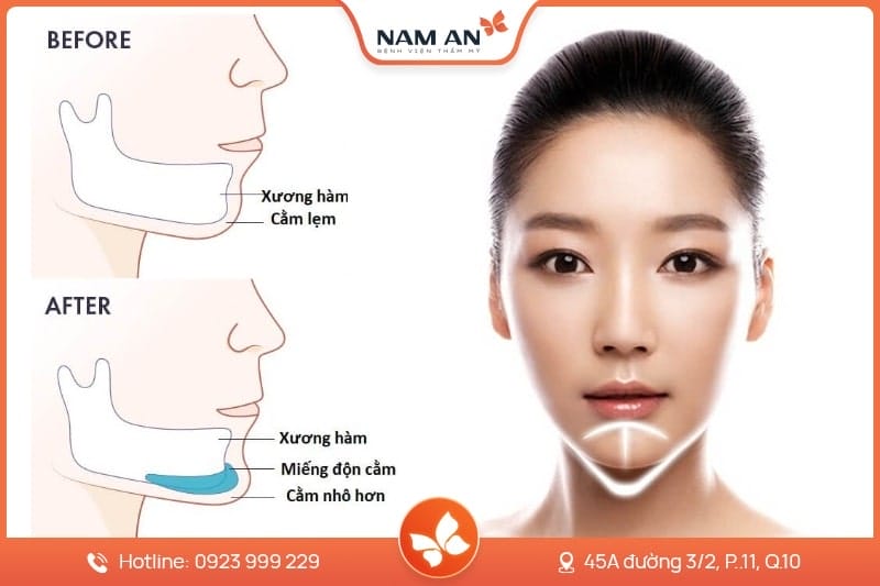 Nâng cằm phẫu thuật — khi nào nên cân nhắc miếng độn cằm hoặc phẫu thuật xương (genioplasty)?