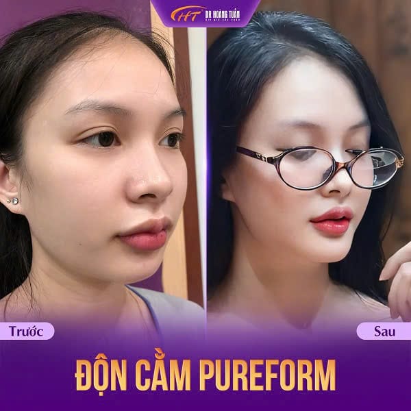 Tiêu chí chọn cơ sở nâng cằm an toàn tại HCM, Hà Nội và Cần Thơ