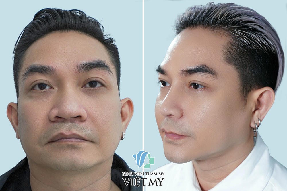 Các lựa chọn thay thế và phối hợp để có cằm thon, hài hòa hơn