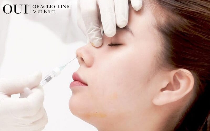 Quy trình an toàn khi nâng mũi bằng filler: vai trò hyaluronidase và các bước giảm rủi ro