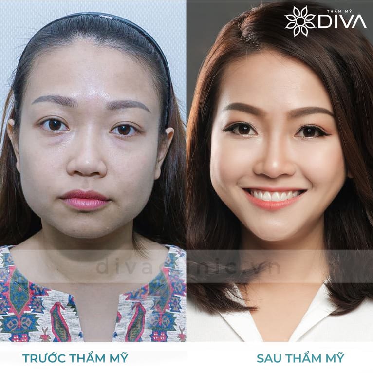 Loại filler nào thường dùng cho mũi và Lona Skin Lab ưu tiên những dòng nào?