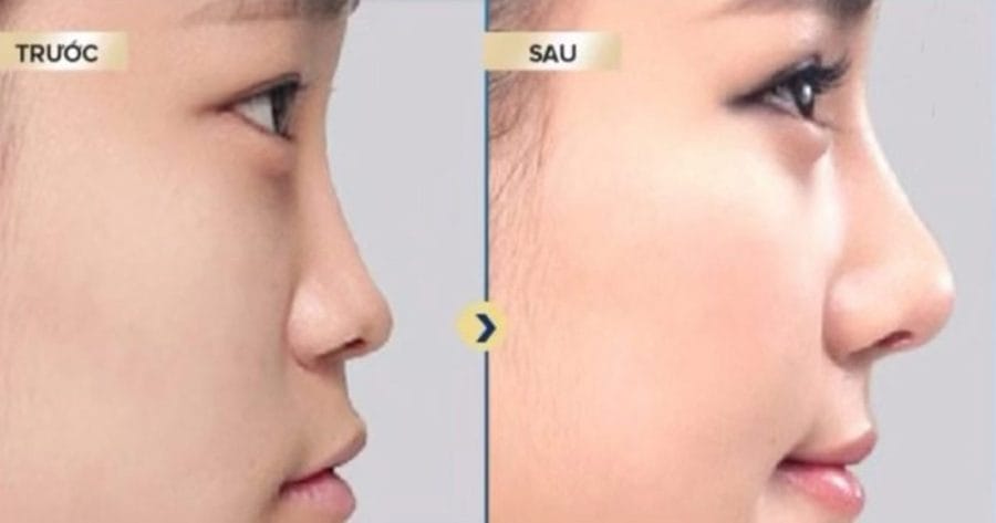 Bằng chứng lâm sàng nào nói về tần suất và xử trí biến chứng khi tiêm filler mũi?