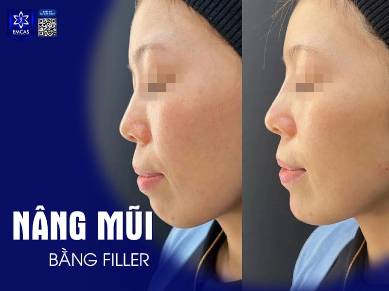 Nếu đang dùng thuốc hay có bệnh nền thì có thể tiêm filler mũi được không?
