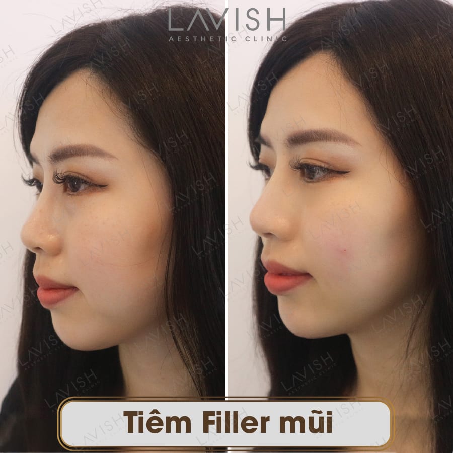 Tiêm filler mũi có hiệu quả kéo dài bao lâu và có thể tháo ra không?