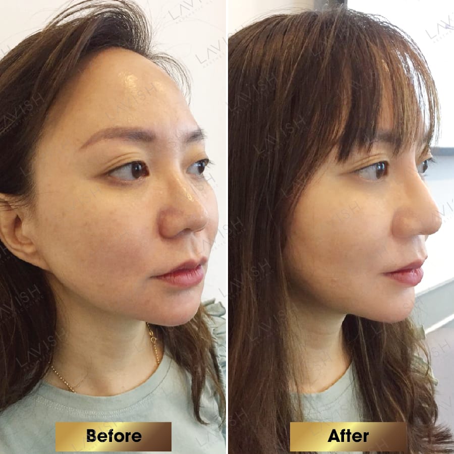 Quy trình tiêm filler mũi an toàn tại clinic cần bao gồm những bước nào?