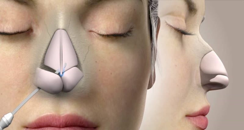 Tiêm filler cho mũi đã phẫu thuật có những rủi ro gì và làm sao giảm thiểu?