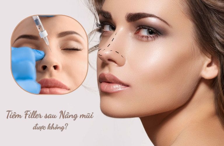 Khi nào không nên tiêm filler sau nâng mũi?