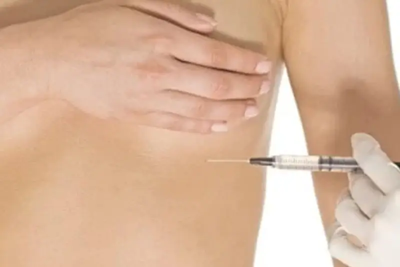 Cấy mỡ tự thân (fat grafting)