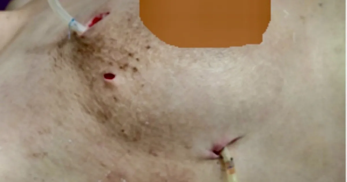 Nếu đã từng tiêm filler ngực và giờ có biến chứng thì xử lý ra sao?