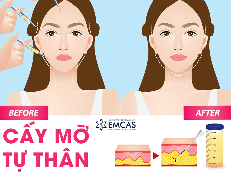 Vậy mỡ tự thân (ghép mỡ) có điểm mạnh gì và khi nào nên ưu tiên?