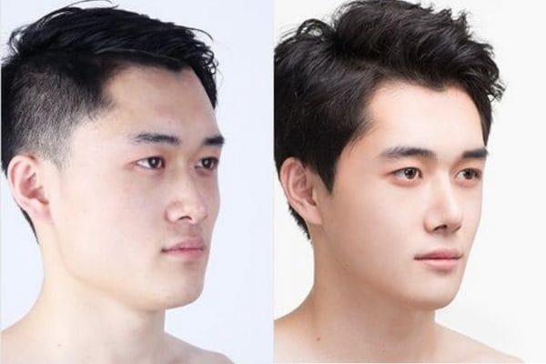 Những lựa chọn sản phẩm và ưu tiên — khi chọn filler HA cho mũi