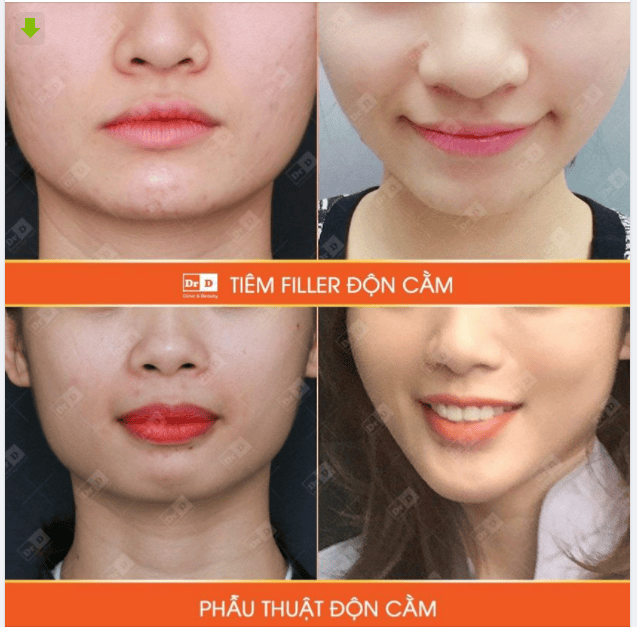 Tiêm filler cho cằm có an toàn không — tác dụng, thời gian giữ hiệu quả và rủi ro là gì?