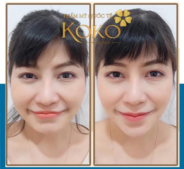 Chuẩn bị trước khi tiêm filler