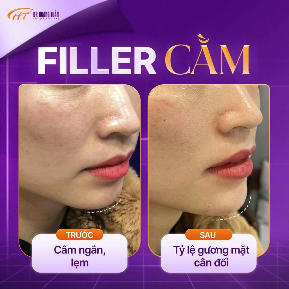 Các lựa chọn filler và khuyến nghị về sản phẩm (gợi ý cho khách hàng tìm hiểu)