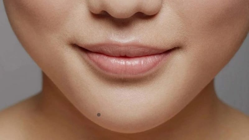 Rủi ro và tác dụng phụ — điều chị em thường lo nhất là sẹo và tái phát, điều này thế nào?