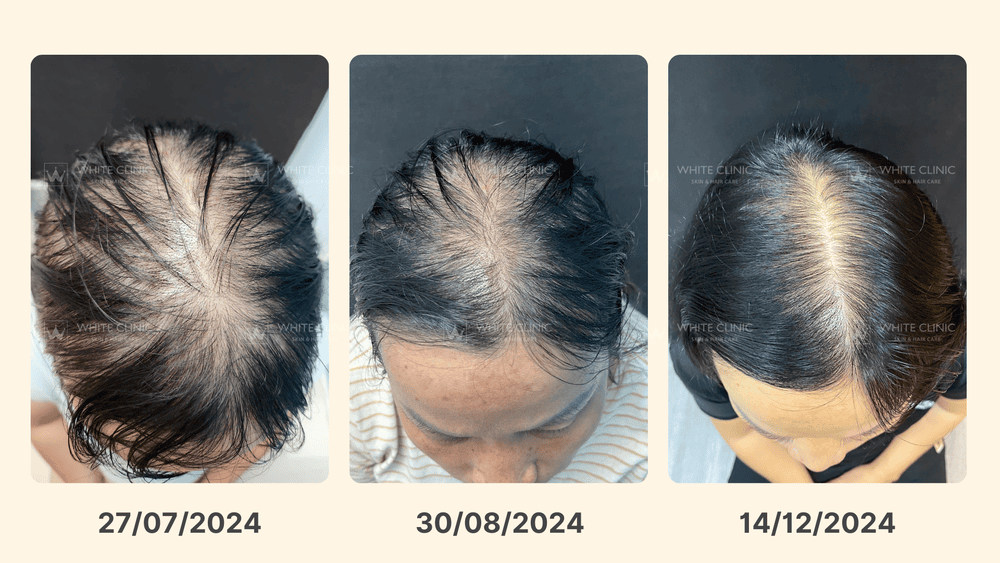 2. Rụng tóc kiểu nữ (Female pattern hair loss)